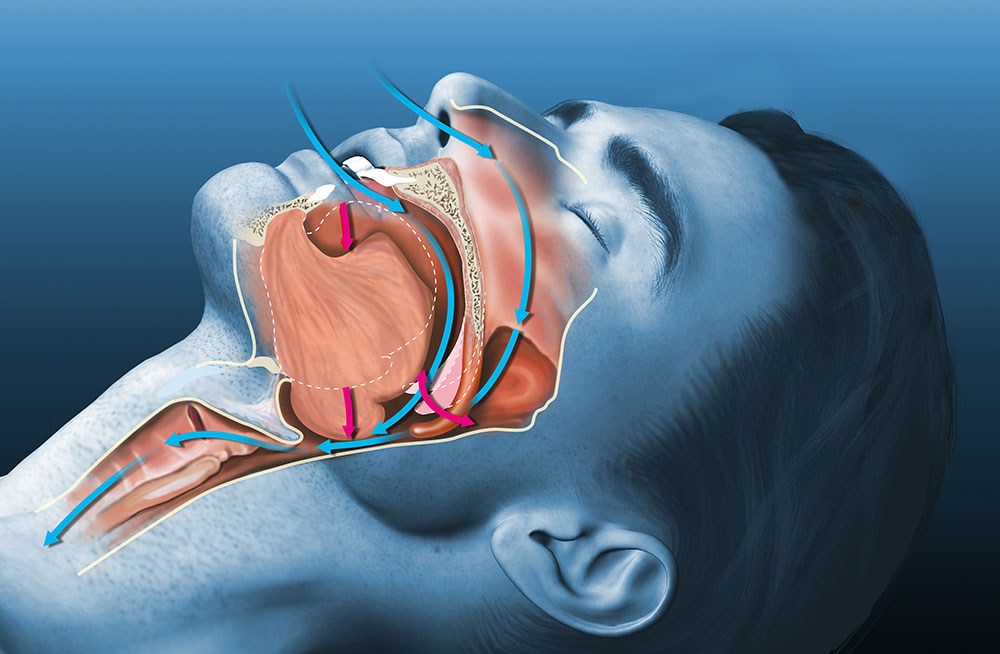 Sleep Apnea & Snoring Treatment | CPAP Alternatives in Des Moines ...